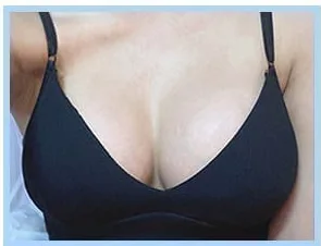 Фото через 3 недели после маммопластики 4