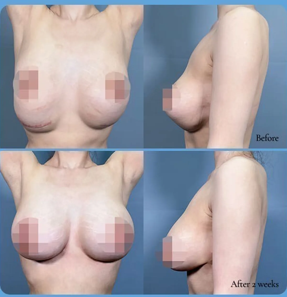 Фото до и после коррекции опущения импланта — Before / After 2 weeks (спереди и сбоку)