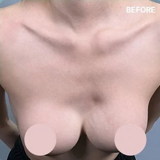 Фото верхней части груди до процедуры устранения риплинга