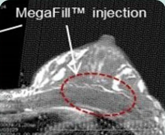 MegaFill™ injection — КТ груди в боковой проекции с отмеченной зоной имплантации