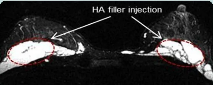 HA filler injection — аксиальная МРТ обеих молочных желёз с отмеченными зонами введения филлера