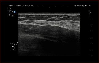 Healthy Breast УЗИ имплантов img10 m
