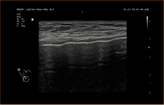 Healthy Breast УЗИ имплантов img11 m