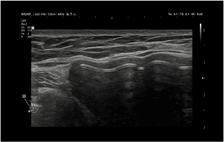 Healthy Breast УЗИ имплантов img6 m