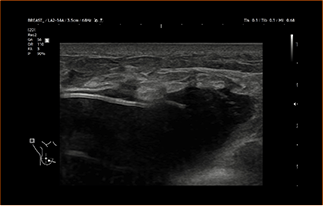 Healthy Breast УЗИ имплантов img8 m