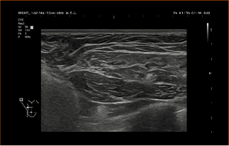 Healthy Breast УЗИ имплантов img9 m