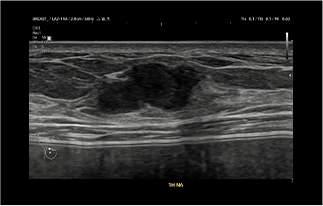 Healthy Breast УЗИ на рак груди img10 m