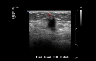 Healthy Breast УЗИ на рак груди img11 m