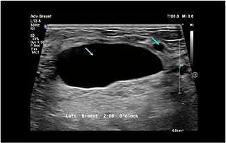 Healthy Breast УЗИ на рак груди img12 m