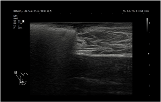 Healthy Breast УЗИ на рак груди img14 m