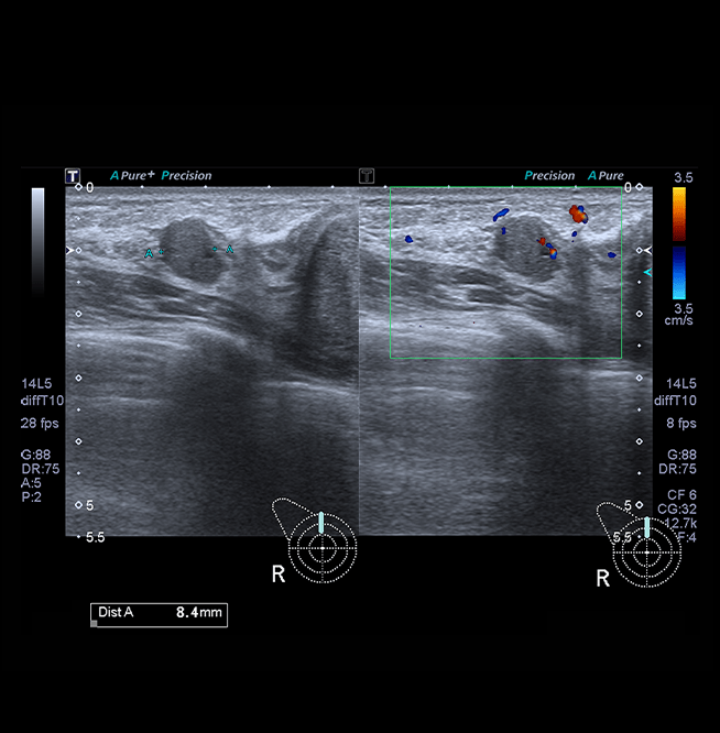 Healthy Breast УЗИ на рак груди img17 m