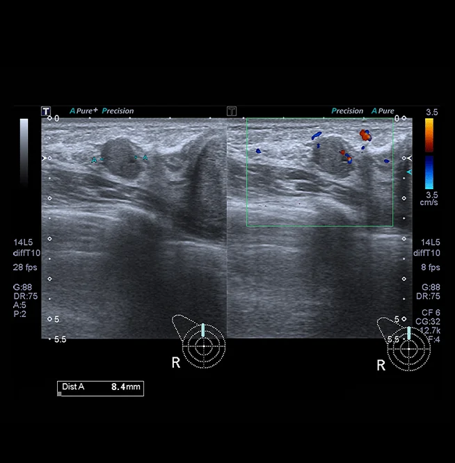 Healthy Breast УЗИ на рак груди img17 m