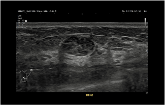 Healthy Breast УЗИ на рак груди img9 m