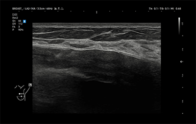 healthy breast УЗИ имплантов img10