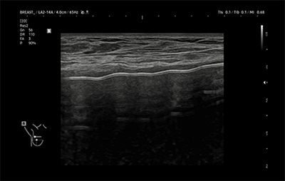 healthy breast УЗИ имплантов img11