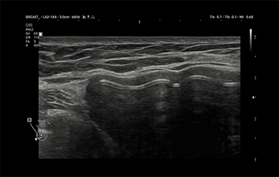 healthy breast УЗИ имплантов img6