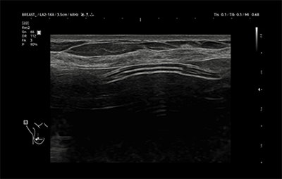 healthy breast УЗИ имплантов img7