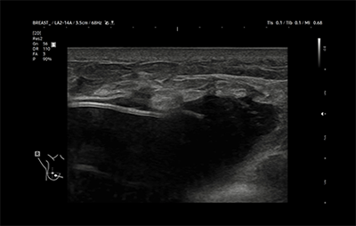 healthy breast УЗИ имплантов img8