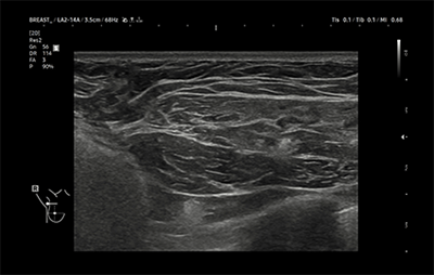 healthy breast УЗИ имплантов img9