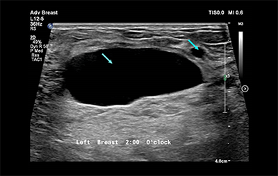healthy breast УЗИ на рак груди img10