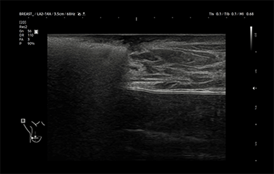 healthy breast УЗИ на рак груди img12