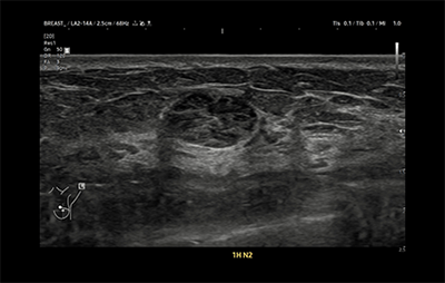 healthy breast УЗИ на рак груди img7