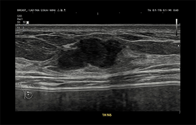 healthy breast УЗИ на рак груди img8