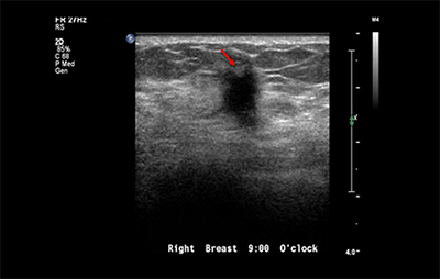healthy breast УЗИ на рак груди img9